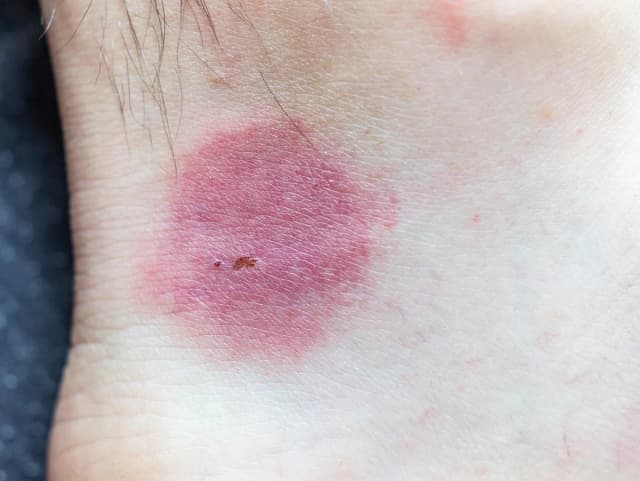 Objawy ugryzienia pająka: jak rozpoznać niebezpieczne symptomy Objawy ugryzienia pająka: jak rozpoznać niebezpieczne symptomy